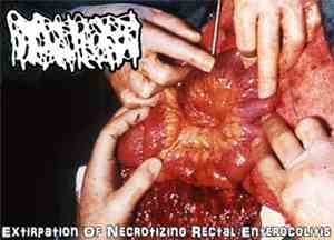 Hydrocephalus - Extirpation Of Necrotizing Rectal Enterocolitis