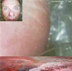 Siegmar Fricke - Restenosis