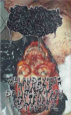 Human Stench Rests In The Morgue / Melanocytic Tumors Of Uncertain Malignan ...