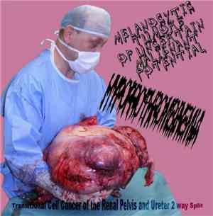 Melanocytic Tumors Of Uncertain Malignant Potential, Hypoprothrombinemia -  ...