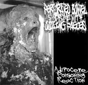 Perforated Bowel Syndrome With Oozing Faeces - Adipocere Poisoning Reaction