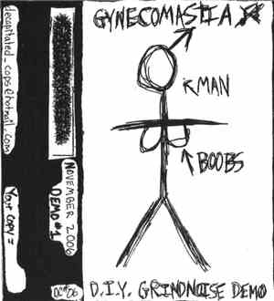 Gynecomastia - Demo #1